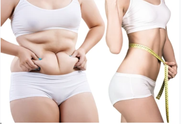 شفط الدهون بالفيزر